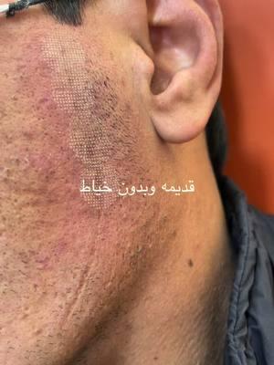 #ليزر#فراكيشنال#تلتو #زراعه_الشعر #الاردن_فلسطين_العراق_سوريا #الاردن #عمان#الزرقاء_الجديدة #المفرق #وشم العقبه#العقبه_الاردن #الاردن_السعوديه_قطر #الاردن#فراكيشنالليزرلعلاجتصبغاتبالوجه #فراكيشنال #co2 