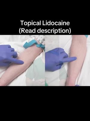 The original IV video course was updated last year and has new content added to meet the revised INS Standards of Practice. This kind of update will happen periodically when new standards are released or new best practices are identified. If you buy any of my courses, you’ll have lifetime access to any updated material I add in the future 😊 . There’s a whole section on pain management including topical and injectable lidocaine, vein marking techniques, and a few new full-length demonstrations! The brand new ultrasound course has a large section on pain management as well and focuses on injectable lidocaine. Check it out by clicking the link in my profile or head to www.theivguy.com/courses (they’re all 30% off and come with CEUs!!!) . Pain associated with venipuncture is often overlooked in the adult population, but is still extremely important and we need to do what we can to reduce pain as much as possible, whenever possible. . Topical anesthetic can be an easy, effective method of doing so, though it does take some extra time. . Palpate for a couple appropriate vessels, apply topical anesthetic and cover with a transparent dressing for 30-45 minutes. Go do some other tasks, then come back and perform your venipuncture. Your patients will thank you 😊 . If you found this helpful, all my video courses are 30% off!!! Click the link in my profile or go to www.TheIVGuy.com/courses to sign up . #nurse #nursing #rn #rnlife #nurselife #instanursing #nurseproblems #nursingschool #nursingproblems #nursingschoolproblems #nursesofinstagram #nurses #studentnurse #nursingstudent #registerednurse #lvn #instanurse #nclex #nclexrn #nclexprep #nursingclinicals #clinicals #nursingschoolclinicals #nursingstudents #nursinglife #nclexreview #nclexpreparation #nclexquestions #peds #nicu 