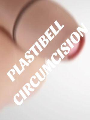 Plastibell Circumcision  Plastibell circumcision is a surgical procedure to remove the foreskin (prepuce) of the penis using a plastic device called a Plastibell. #PlastibellCircumcision #CircumcisionSurgery #BabyHealthcare #MedicalProcedure #ChildHealth #PlastibellCare #CircumcisionProcess #ParentingTips #NewbornHealth #SurgicalProcedure