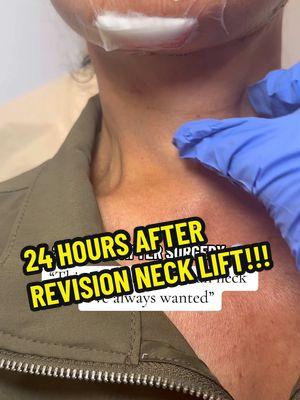 24 hour transformation 😱🕒 Our amazing 64 year young patient disliked the loose excess skin she had on her skin. She had 2 previous facelifts (done elsewhere) and was dissatisfied with her results. She wanted to feel confident & youthful again!!  We performed a: ➡️ Revision Face & Neck Lift ➡️ Endoscopic Brow Lift ➡️ Lip Lift ➡️ Chin Augmentation (replacement) She is only 24 HOURS post-op and she is feeling great with minimal pain. Check out how tight and cleaned up her neck is 👀 She does not look aged & tired anymore!!  Stay tuned for her progress pictures & videos in the upcoming weeks 😊 What do you guys think about this transformation? Let us know in the comments ⬇️ To schedule an appointment:   ☎️ 212-288-3000  📲 WhatsApp: 201-875-8482 💌DM  Locations: 📍65 East 66th Street, New York, NY 10065 📍81 North Maple Avenue, Ridgewood, NJ 07450 #facelift #beforeandafterfacelift #bestfacelift #faceliftnyc #faceliftnj #bestfaceliftsurgeon #plasticsurgery #bestplasticsurgeon #scarlessfacelift #necklift #liplift #miamiplasticsurgeon #browlift  Disclaimer: I do not own or claim to own the audio in this video.