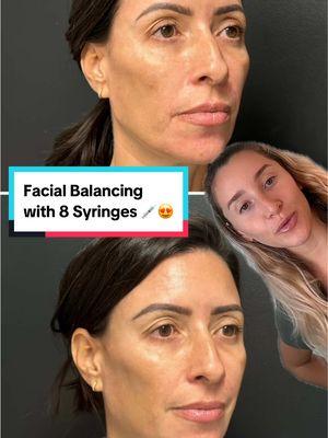 ✨ Facial Balancing at Its Finest ✨ Our injector Chloe @Themedicalmind worked her magic with 8 syringes of filler, creating beautifully natural and harmonious results for her patient. The best work? It’s undetectable—you’ll look refreshed, not “done.” 💉 🔑 The Secret: Chloe tailors every treatment to your unique anatomy, ensuring seamless integration with your natural features. Her strategic approach means you can confidently enjoy the benefits of filler without worrying about concerns like migration. When you trust a skilled injector, your results are as safe as they are stunning. 💕 🌟 Now is the time! Take advantage of 25% off your next facial balancing treatment—this offer is as rare as it is exciting! Don’t miss your chance to save; this special is available now through the end of January. 👩‍⚕️ Ready for your glow-up? Let Chloe design a custom plan just for you. 📍 Asia Pacific Plastic Surgery 📍 Honolulu, Hawaii #FacialBalancing #NaturalResults #HawaiiMedSpa #DrShimChing #Hawaii #Honolulu #BotoxHawaii #HawaiiMedSpa #DrShimChing #PreventativeBotox #WrinkleFree #NaturalResults #AestheticConfidence #HonoluluInjectables #GlowUpWithBotox #HawaiiBeautyExperts #HonoluluPlasticSurgery #TimelessBeauty #ConfidenceBoost #InjectablesMadeEasy #WrinklePrevention #YouthfulGlow 