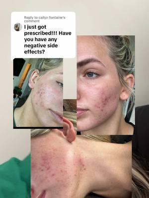 Replying to @cailyn fontaine lmk if yall have any more questions!! #fyp #skinjourney #acnejourney #skin #acne #spirnolactone #acnetok #viralskincare @Dan Hatef, MD 