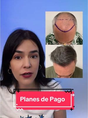 Tenemos varias opciones para que pagues tu cirugía poco a poco. Una de nuestras coordinadoras te puede dar información en linea. Solo comenta “pagos” #LIVEhighlights #TikTokLIVE #LIVE #hairtransformation #hairtransplant #trasplantecapilar #financiamiento #pagos 