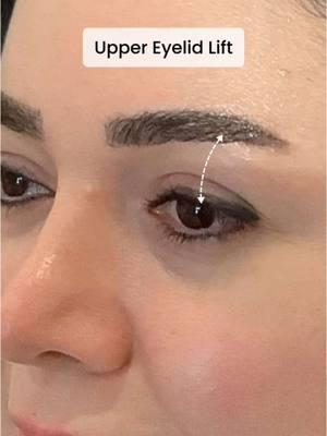 #endolift for upper eyelid .. this laser works for non-surgical #blepharoplastie #bleph thanks to combination of laser treatments and magical touch of  Dr. K ! Results don’t lie ! #pchmedspa #bestresults #endolift #toskani #boosters #skintighening🤩 #lasers #endoliftlaser #newportbeach #losangeles #blepharoplsty #blepharitistreatment #eyelidlift #eyelift #hoodedeyes #hoodedeyelids 