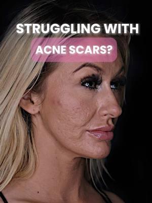 Struggling with Acne Scars?⚡️👏🏼 #acne #scars #face #laser #treatment #doctor #youtube #trending #viral #relatable #beauty #skin #beautifulskin #goals #skincare #aesthetics #antiaging  