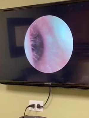 Now this is an earwax removal! 🤩  #ear #satisfying #eartok #earwaxremoval #wax #earcleaning #CleanTok #waxtok #hearingloss #hearing #betterhearing