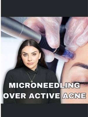 Back on my bullsh**ttt for 2025!  Microneedling is an INCREDIBLE treatment that got a bad rap because of some unlicensed individuals spreading viruses and bacteria from person to person… HOWEVER…when licensed professionals are spreading a face full of pus by Microneedling over cystic acne, I am completely dumbfounded.  “Stamping” is one way of doing this but there is no heat with microneedling. None of the bacteria is being killed or burned off, it is simple being spread from one pimple to the next, so…sorry, not sorry…microneedling over cystic acne is a HARD PASS at TSC. #microneedlingoveracne #acnemicroneedling #activeacnetreatment #microneedlingfail #microneedlingtherapy #losangelesmedspa #thestepanyanclinic #losangelesinjector #nunestepanyan 