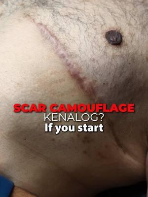 Start your scar camouflage journey today! #scarcamouflage #fakebody #results #plasticsurgery #fakebodyy⚠️ #lasvegas #fyp #fypシ 