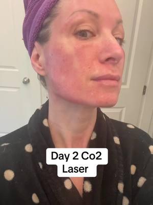 CO2 laser results day 2. 🍅😱 #co2 #co2laser #co2skinresurfacing #skinlaser #laserskincare #melasma #melasmatreatment #acnescars #fractionallaser #hyperpigmentation #over40 #acnescartreatment #perimenopause 