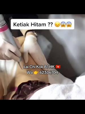 KETIAK HITAM BULU RIMBUN #ketiakhitam #ketiakbulu #buluketiak #solusi bulu ketiak lebat #burket #buluketiaklebat 