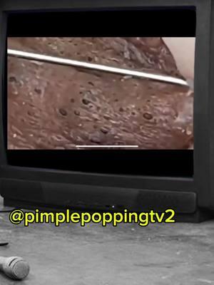 #fyp #pimplepopping #pimplepopper #whiteheadremoval #pimple #satisfyingvideo 