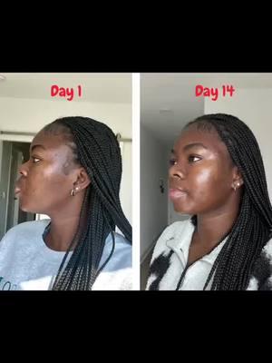 "Wow, my before and after from Palmer's 14 Day Skin Success Challenge is crazy. Watch my dark spots and uneven skin tone transform into a radiant glow" @hydeemma19 #palmers #myskinsuccess #skinsuccess #facecare #fadecream #facecream #acne #scars #darkspots #glowingskin #moisturize #SelfCare #selfcareroutine #skincare