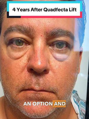 4 Years After Quadfecta Lift (upper & lower blepharoplasty + fat transfer + skin tightening) 📍Beverly Hills, CA. #eyes #eyebags #hoodedeyelids #kamiparsa #quadfectalift #puffyeyes #darkcircles 