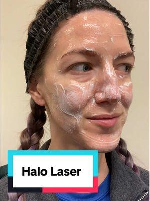 Come with me to get a halo laser treatment! #halolaser #laserfacial #Halo #skincare 