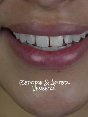 Before and after #veneers #morph #teeth #CapCut 