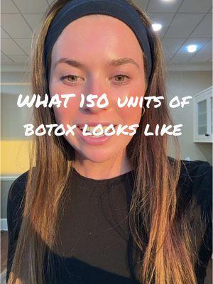 What 150 units of botox looks like … I also like using dysport or Daxxify too just depends on what I have on hand  #atlantainjector #dysportinjections 