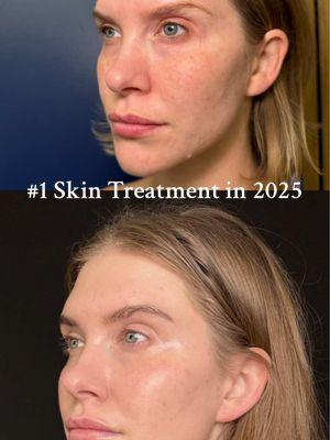 1 #1 Skin Treatment for 2025: Tetra CoolPeel Ok! Here is why the CoolPeel is on my 2025 IN list! *First I’d like to say that I am not financially incentivized. Any device, skin care line, marketing company that I recommend to you is because they are genuinely the best. So let’s get into it. Tetra CoolPeel = CO2 Laser 	⁃	For ALL skin types 	⁃	Little to no downtime 	⁃	Little to no pain (and I’m a BABY) 	⁃	Incredible results! 	⁃	Short treatment times! For my med spas: 	⁃	Zero consumable cost 	⁃	Great and easy to demo (hand treatments) 	⁃	Great for give aways, raffles and add values 	⁃	No numbing & short treatment times 	⁃	Save Time = Make more money 	⁃	Patients always come back to finish their series and they love the results! 	⁃	I love @Cartessa Aesthetics as a company - they have great reps that are honest and kind 🚩Which of my INs and OUT list should I unpack next??? #Medspa #skincare #antiaging #microneedling #coolpeel #co2 #co2laserskinresurfacing #medicalspa #injectables #socialmediamarketingtips #skincareroutine #growyourpractice #medspalife #marketingstrategy #medspamarketing 