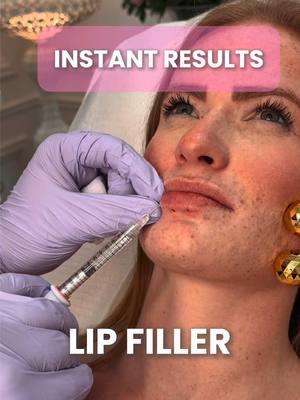 Instant results with Lip Filler!💉👄 #fyp #doctorsoftiktok #face #lipfiller #lip #aesthetics #medspa #beforeandafter #face #antiaging #medspalife #viral #trending #doctorsofyoutube #doctor #medical #beautyjourney 