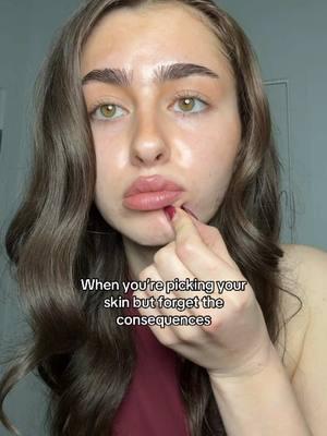 Is that HYPERPIGMENTATION  #skinpicking #acne #acnescars #discoloration #hyperpigmentation 