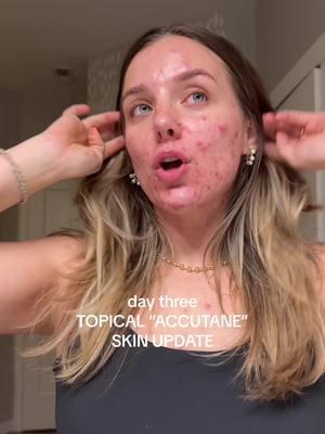 DAY 3 POST AEROLASE LASER UPDATE ON CYSTIC ACNE SKIN [round two]  @Sydneyhuntleyesthetics @Aerolase® Laser Skin Health #acne #acneskin #acnetreatment #acnelaser #aerolase #facelaser #pcos #pcostreatment #unwantedhair #laserhair #laserhairremoval #pcosproblems #accutane #acnescars #guthealth #integrativemedicine