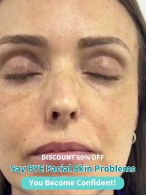 Qw This serum is solution for pigmentation problems...#freckles #skincare #aobenz 