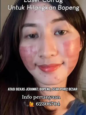 yang punya bekas jerawat Scar bopeng YUKSS mulai perawatan YUKSS,,, #laserco2franctional #laserco2 #laserfractionalco2 #bopengtreatment #bopengjerawat #bopengtreatment #mulus #glowing #wajahglow 