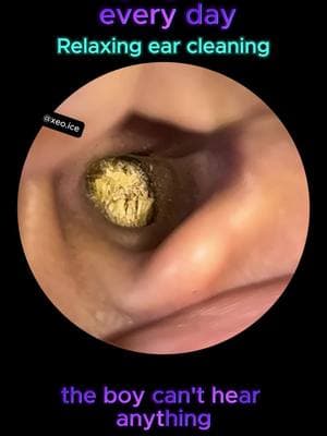 Amazing 🥰 #earwax #ear #earwaxremoval #satisfying #asmr #relax 