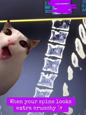 #crunchycat #crunchycatmeme #spine #spinalfractures #sticklersyndrome #chronicpain 