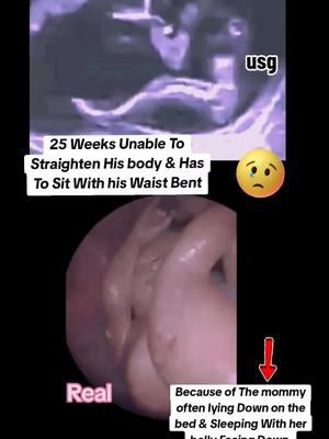 25 Weeks baby unable to Straighten his body inside Womb during ultrasound scan #babyultrasound #pregnancy #babyultrasoundpost✨ #pregnanttiktok #babyultrasound👣💙 #babyultrasound🤰✔️ #pregnancyultrasound #babyinsidebelly #babyinside 