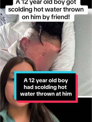 A 12 year old Georgia boy had scolding hot water poured on him by friends and got 2nd degree burns on his face! #fyp #foryou #crime #truecre #georgia #hot #water #burns #friends #teen #preteen #friends #police #news #viral #viralvideo #xyzbca