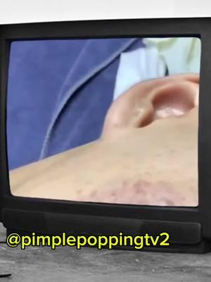 #fyp #pimplepopping #pimplepopper #whiteheadremoval #pimple #satisfyingvideo 