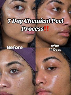 ‼️ANSWERING ALL CHEMICAL PEEL QUESTIONS to the best of my ability in the comments below ⬇️ 7 DAY FULL PROCESS Chemical Peel on Brown Skin for my acne scars, dark spots, hyperpigmentation. If you choose to get this procedure PLEASE consult a board certified dermatologist I go to @drninadesai in manhattan beach 🤎  #chemicalpeel#brownskin#darkspots#acnescars#hyperpigmentation#vipeel#discoloration#browngirlskincare