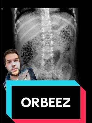 #greenscreen Orbeez are dangerous #danger #pediatrics #orbeez #iatethat #eat #ate #SBO 