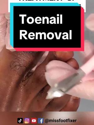 BIG GAP IN DAMAGED Toenails! Perfectly trimmed #nailcutting #missfootfixer #toenailcare #toenailremoval #toenailfungustreatment 