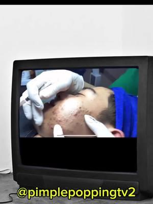 #fyp #pimplepopping #pimplepopper #whiteheadremoval #pimple #satisfyingvideo 