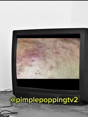 #fyp #pimplepopping #pimplepopper #whiteheadremoval #pimple #satisfyingvideo 