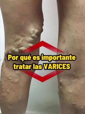 Por qué es importante tratar las varices #nutriya #varices #malacirculacion #coq10 #uñadegato #medicinanatural #remedioscaseros 