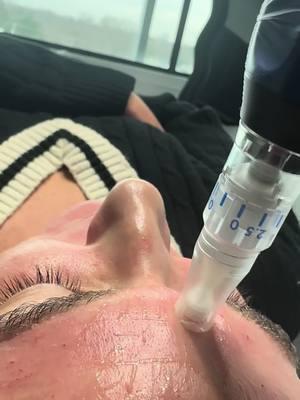 A day in my life as an Esthetician/Nurse… . . .  #skin #extractions #Halo #sundamage #profractional #laser #skincare #esthetician #nurse #medspa 