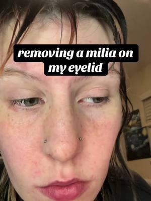 #miliaremoval #milia #extractions #skincare #miliaextraction 