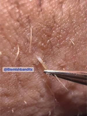 Just a lil distraction for ya ✨Enjoy✨ . #blemishbandits #blemish #blemishes #cloggedpores #ingrownhairs #extraction #pimple #pimplepopper #acne #skin #skincare #clean#picking #fyf #fyp #viralvideo #xyzbca 