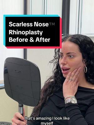 Changing lives… one Scarless Nose® at a time.  Learn more:  🌐 Scarless Nose® https://www.scarlessnose.com (https://www.scarlessnose.com) 📞 Call/text (USA): (424) 722-3484 🌎 International Patients (WhatsApp): (+1-310-276-1703) 📩 Immediate Assistance: https://www.scarlessnose.com/contact/ (https://www.scarlessnose.com/contact/) 📍 Beverly Hills Rhinoplasty Center, Beverly Hills, CA #nosejob #rhinoplasty #closedrhinoplasty #be strhinoplastysurgeon #scarlessrhinoplasty #bestrhinoplasty #scarlessnosejob #bestnosejob #drdugar #fypシ゚viral 