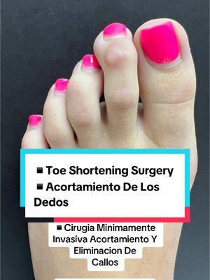 COSMETIC FOOT SURGERY IS VERY MUCH “A THING.”👠 🇪🇸Speak Spanish  🏖️Miami, Florida  ☎️954 922 7333 📍Link In Bio  #feet #toeshorteningsurgery #toeshortening #cirugia #cirugiadepie #acortamientodelosdedos 