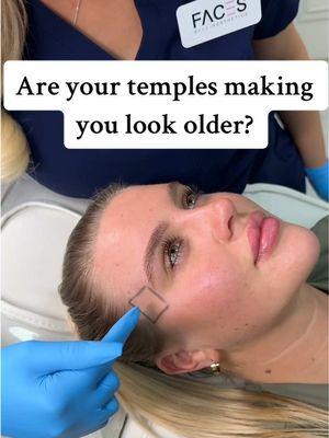 Temple Filler at Faces As we age we lose volume in our temples which makes us appear older. This lost volume causes the area to sink in and look hollow, which in turn makes your brow sit lower. This ages the face as it changes its natural youthful appearance. HA dermal fillers in this area restore the lost volume, making you appear younger and it also helps support and lift the brow too #botox #injections #injectables #aesthetics #jawlineslimming #bumfiller #bumfilleruk #browlift #botoxlift #facelift #facesbyakj 