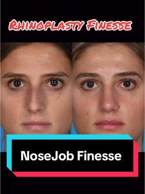 #rhinoplasty #deviatednose #drrodrohrich #bestplasticsurgeon @Newsweek #foryourpage #fyp #beforeandafter #nose #rhinoplastyexpert #rhinoplastybeforeandaafter #foryoupage 