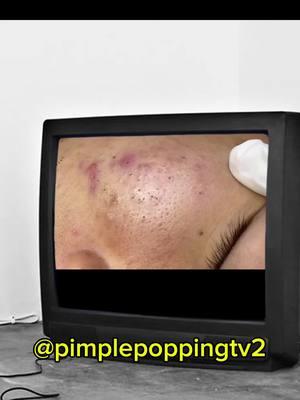 #fyp #pimplepopping #pimplepopper #whiteheadremoval #pimple #satisfyingvideo 