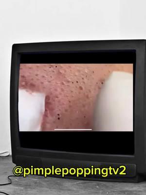 #fyp #pimplepopping #pimplepopper #whiteheadremoval #pimple #satisfyingvideo 