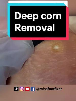 Treatment of Deep Corn Removal by Miss Foot Fixer. #deepcorn #cornremoval #cornremoval #missfootfixer 