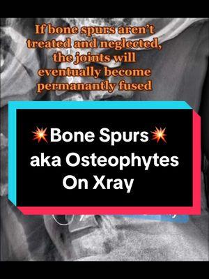 Does your xray show bone spurs? #neckpainrelief #arthritis #bonespurs #stiffness #xray #degenerativediscdisease 