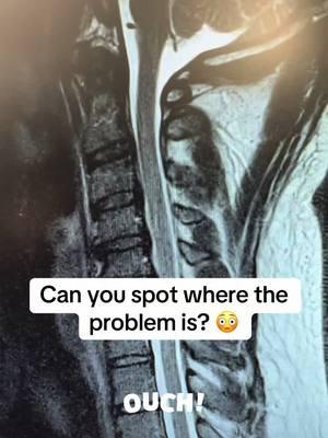 Can you see where the problem is? #DrCyr #SASpine #acdf #neckpain #cervicalpain #neckpainrelief #ORlife 