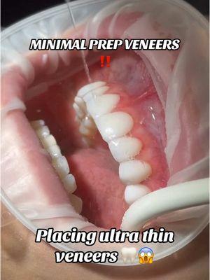 Placing ultra thin veneers over non-prepped teeth 👀‼️ If you’re new to the veneer world, “no-prep” means the original teeth needed little to no adjustment in order to get veneers placed over top DM us to get scheduled for your free consultation! 💻 #veneers #porcelainveneers #cosmeticdentist #dentist #smilemakeover #smiles #dentistry #noprepveneers 